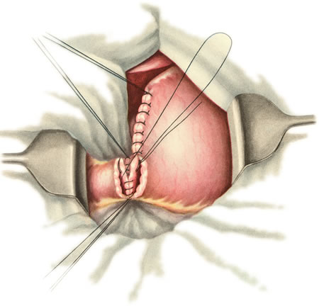 Gastroduodenoanast