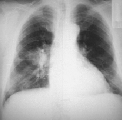 Р рак лёгкого 2(1)