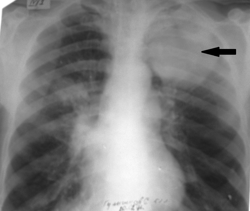 Abscess legkogo1