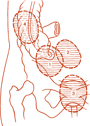 Appendabscess