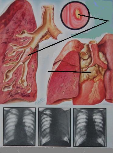 центральный рак лёгкого