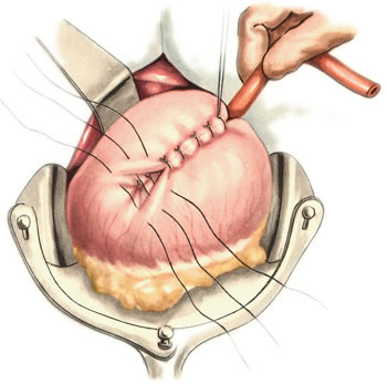 Gastrostomia