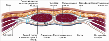 intraperitoneal