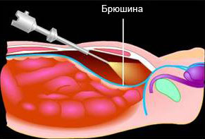 Laparoskopgernio